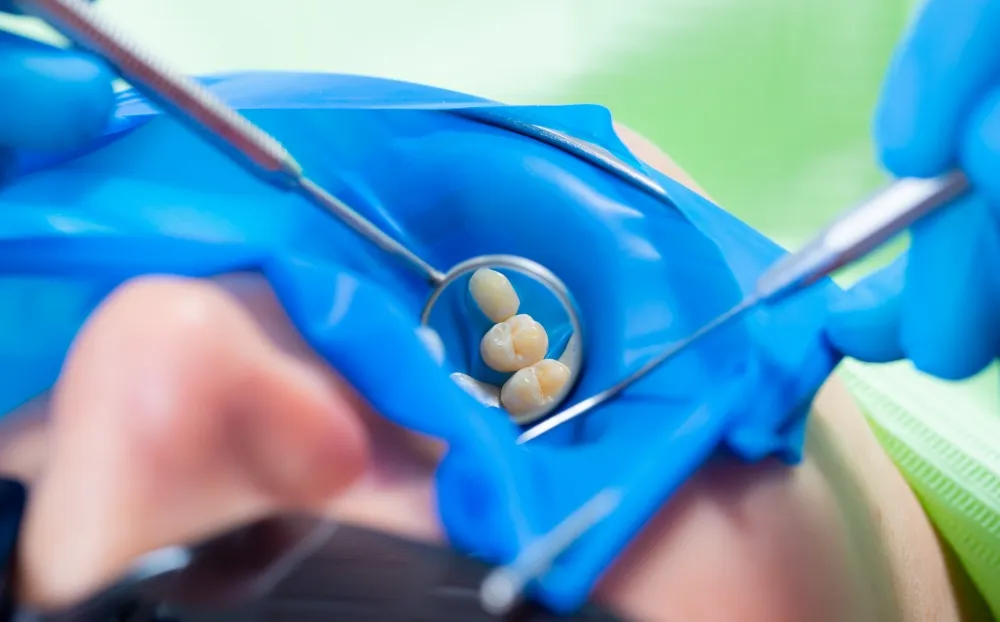 ラバーダム防湿