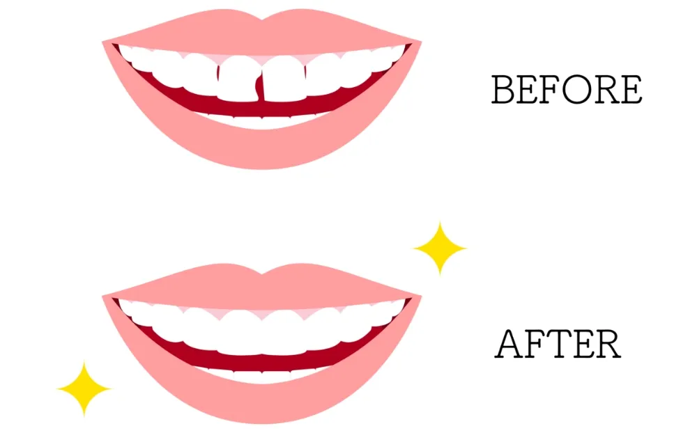 ダイレクトボンディング