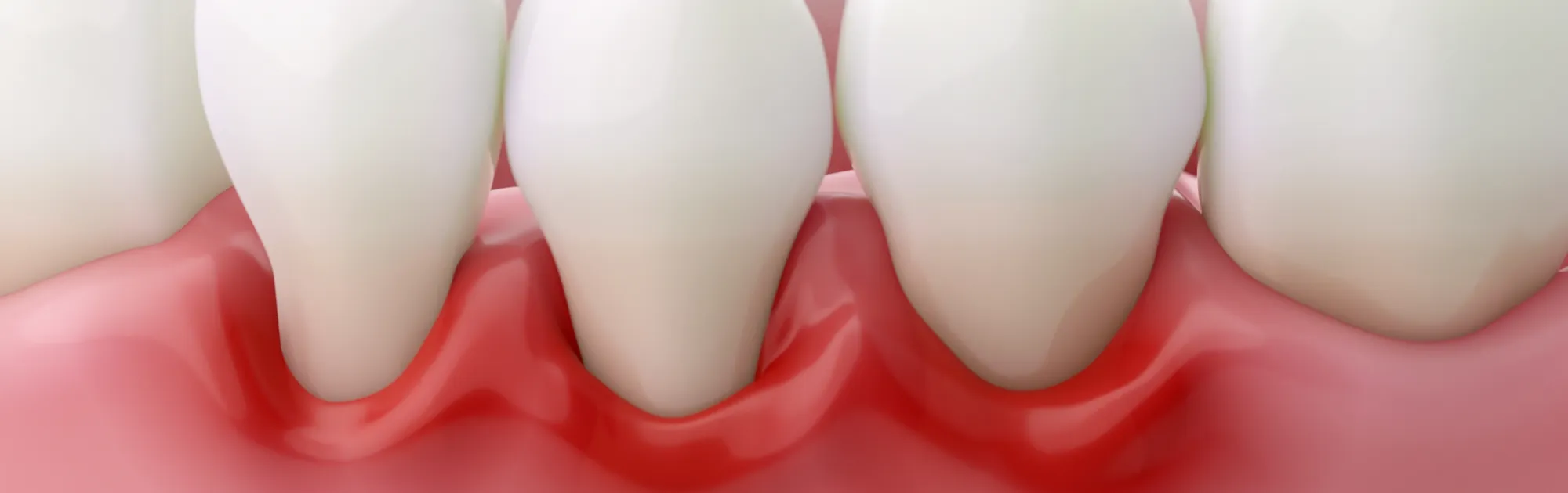 歯周病について