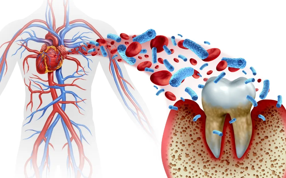 歯周病と全身疾患