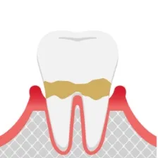 歯周炎（軽度）