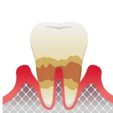 歯周炎（中度）