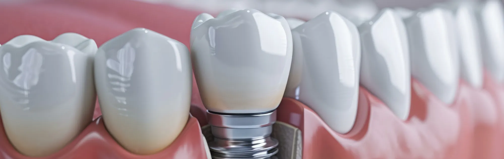 インプラント治療とは