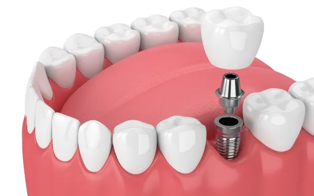 インプラント治療