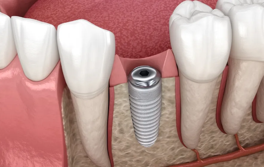 インプラント埋入手術