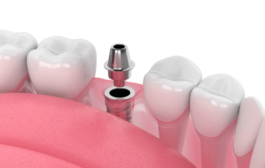 アバットメント取り付け