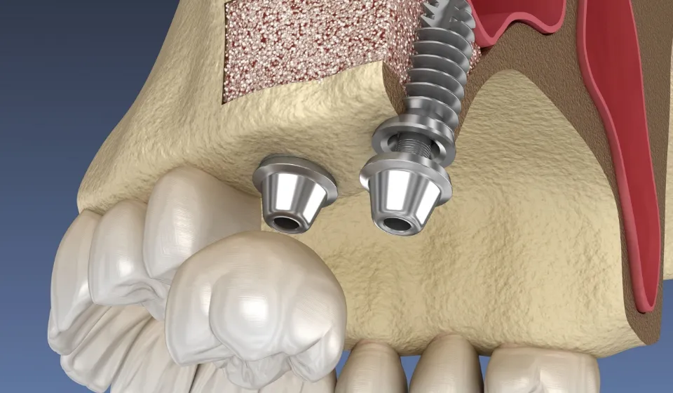 サイナスリフト