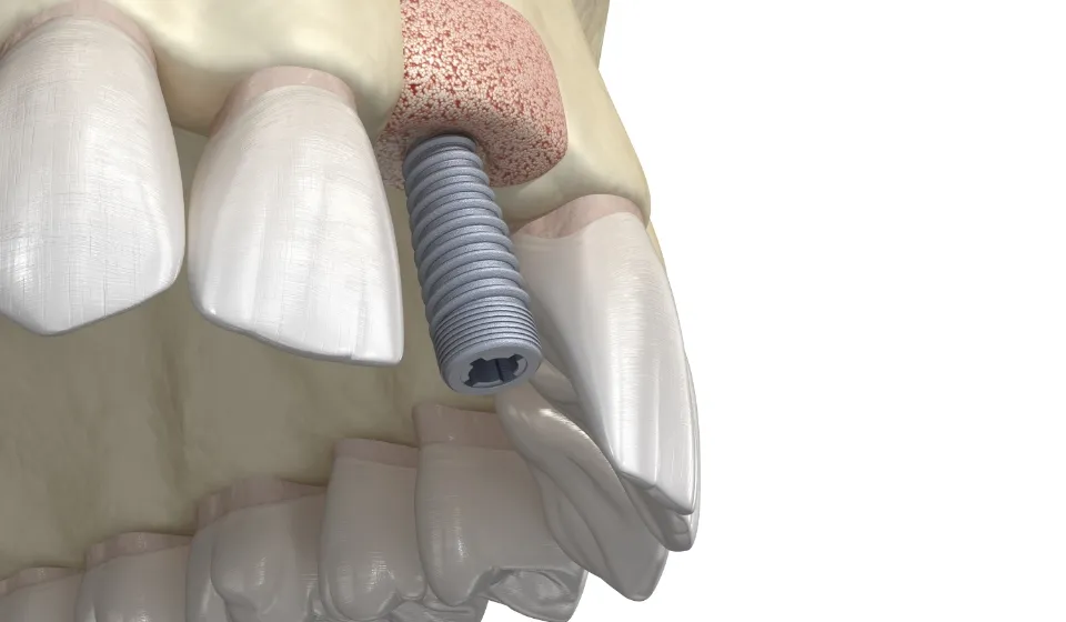 ソケットリフト