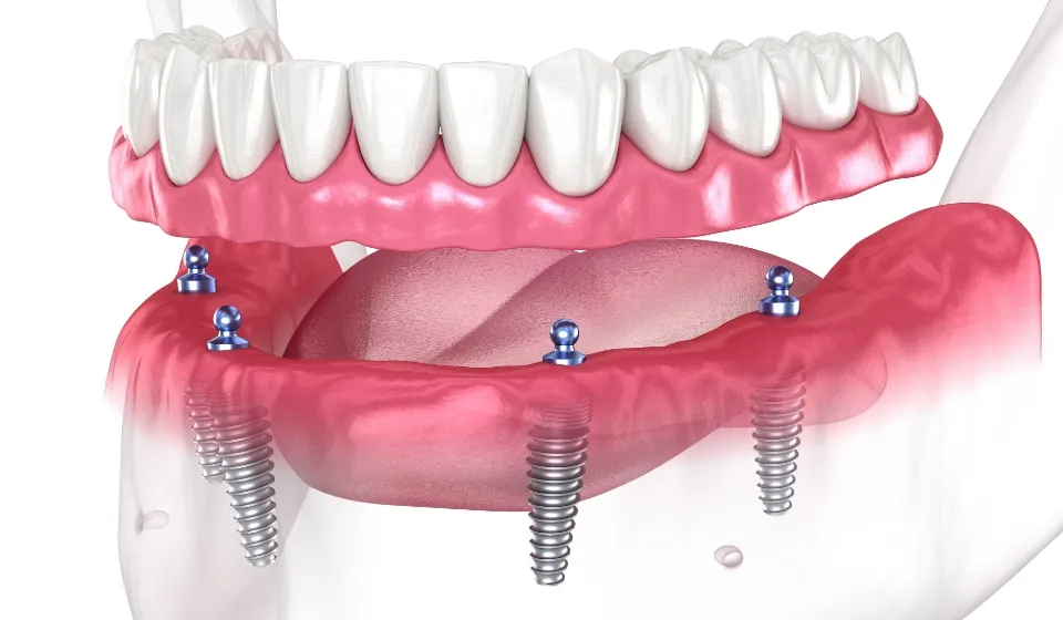 インプラントオーバーデンチャー